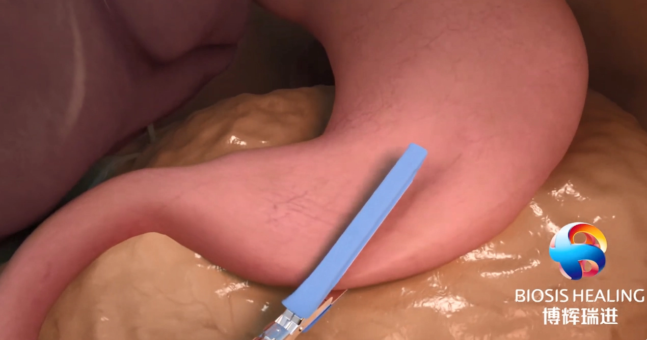 Reforço de linha de grampo (SLR) para reduzir vazamentos