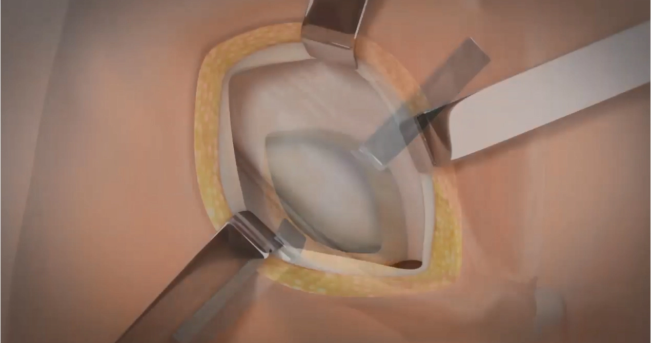 Reparação de hérnia de Lichtenstein com malha absorvível SIS