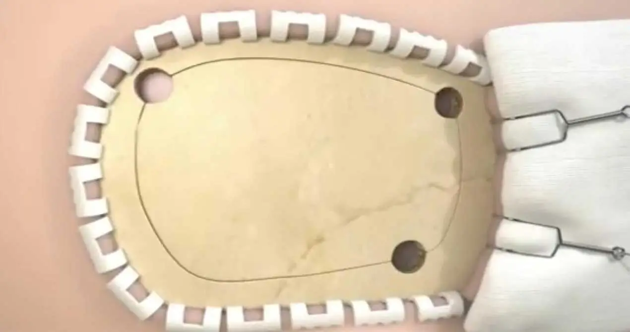 Patch de reparação Dural