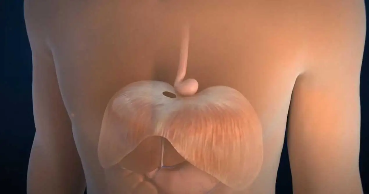 Reparo de hérnia de hiato esofágico com malhas biológicas SIS