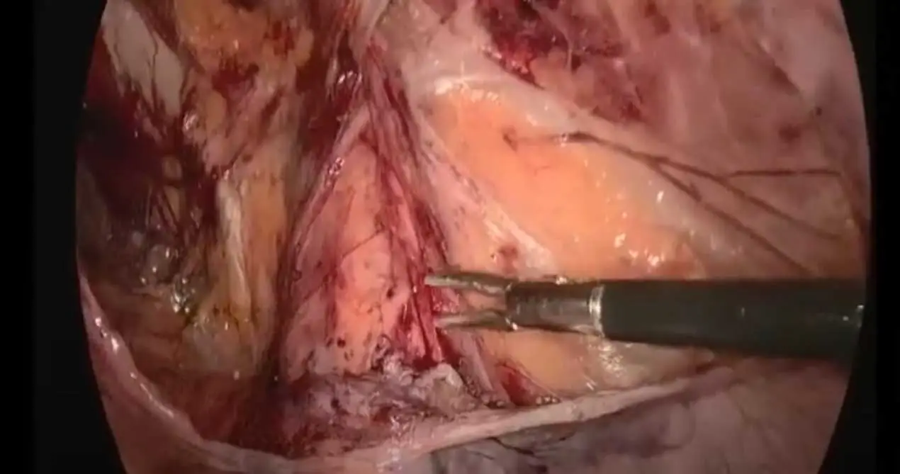 SIS cirurgia de malha biológica 13x15cm TAPP para reparação de hérnia