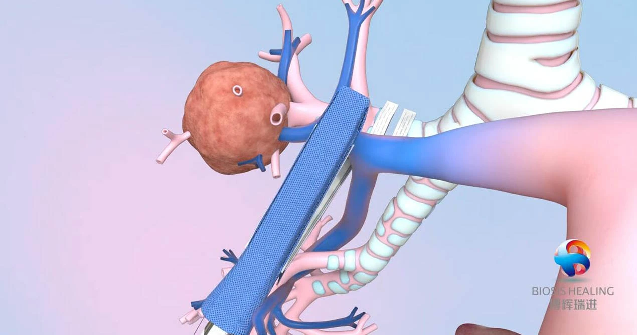 Linha de grampo reforço para lobectomia