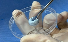 Material de Enxerto de Osso